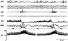 FIGURE 3-5. REM sleep recordings for an individual with OSA.