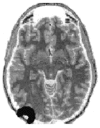 FIGURE 15.1. Schematic representation of the volume in the brain that is explored by a particular source-detector pair located in left occipital areas.