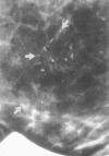 Figure 30F.13. Segmental distribution of fine, linear, branching calcifications (arrows) of intraductal comedocarcinoma.