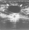 Figure 30F.17. Ultrasonogram of a cyst.