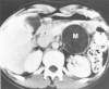 Figure 30D.1. Cystic pancreatic mass.