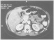 Figure 30D.3. Renal cell carcinoma.