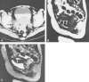 Figure 30D.4. Lymphoma of uterine cervix.