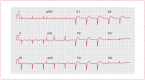 Figure 11. ECG demonstrating abnormal Q waves in V1–V4.