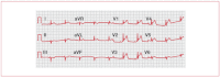 Figure 15. ECG demonstrating anteroseptal myocardial infarction.