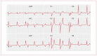 Figure 20. ECG demonstrating a widening of the QRS complex.