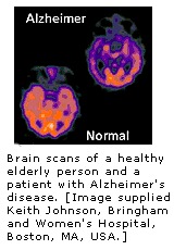 Image Alzheimer.jpg