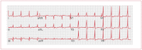 Figure 15. Electrocardiogram of Wolff–Parkinson–White syndrome.