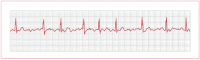 Figure 18. Electrocardiogram of atrial fibrillation with irregular rhythm and absent P waves.