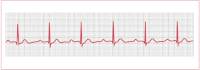 Figure 4. Electrocardiogram of first-degree atrioventricular block.