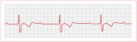 Figure 7. Electrocardiogram of third-degree atrioventricular block.