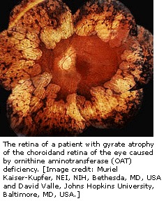 Gyrate atrophy of the choroid and retina - Genes and Disease 