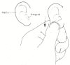 Figure 126.1. Examination of the ear canal and eardrum of a child under 2 years of age.