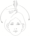 Figure 126.3. Midline positioning of the tuning fork for the Weber test.