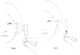 Figure 126.4. Proper positioning of tuning-fork tines for air conduction testing.