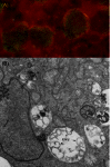  Inclusioni di Chlamydia trachomatis nelle cellule infette.