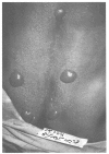 FIGURE 3-1. Vesicle formation on an Iranian patient, 16 hours after battlefield exposure to sulfur mustard.