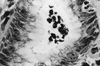 Figure 2. Polymorphs infiltrate the foveloar epithelium, which is colonized by helicobacters.