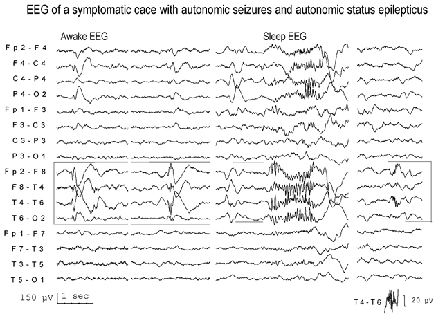 Figure 9.10. EEG of a 10-year-old girl with autonomic seizures and autonomic status epilepticus identical to those of PS (case 60 in ref).