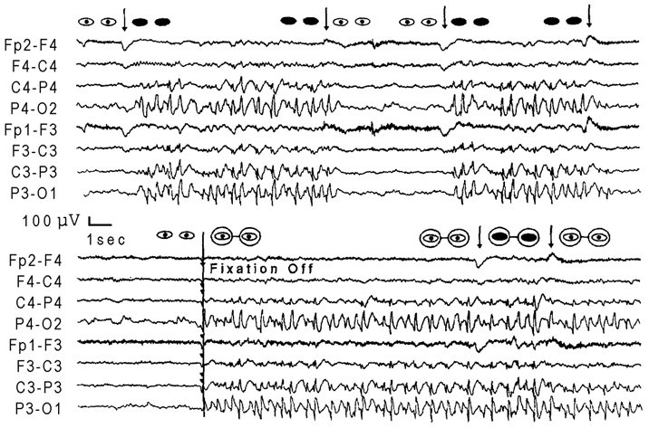 Figure 9.12. Occipital paroxysms in their classical form with fixation-off sensitivity in a 10-year-old boy with Gastaut-type childhood occipital epilepsy (case 26 in ref).