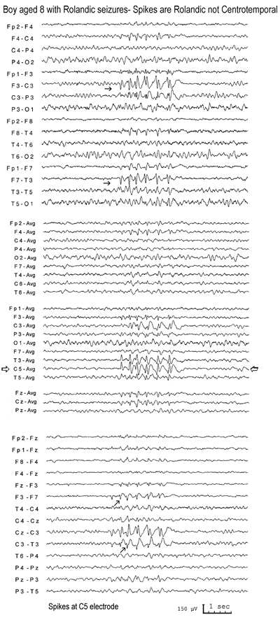 Figure 9.3. Centrotemporal spikes are mainly Rolandic not temporal spikes.