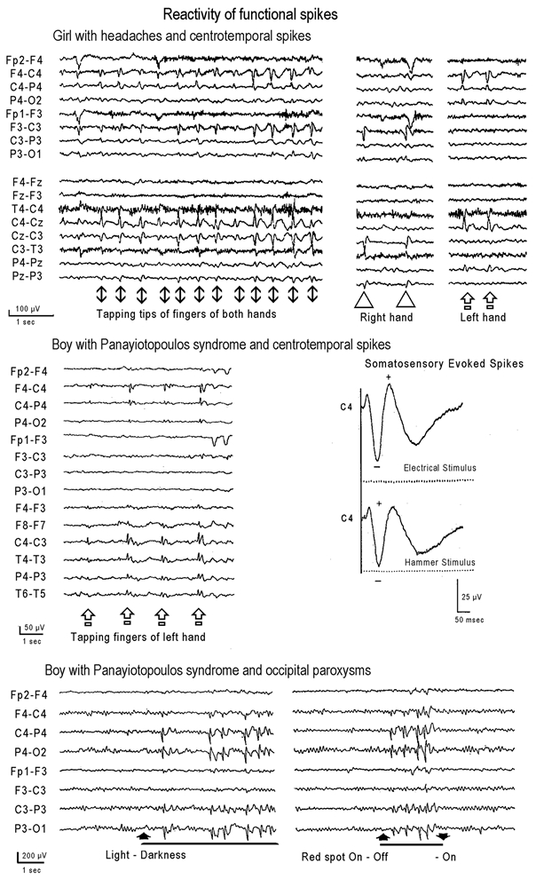 Figure 9.4. Activation of functional centrotemporal and occipital spikes.