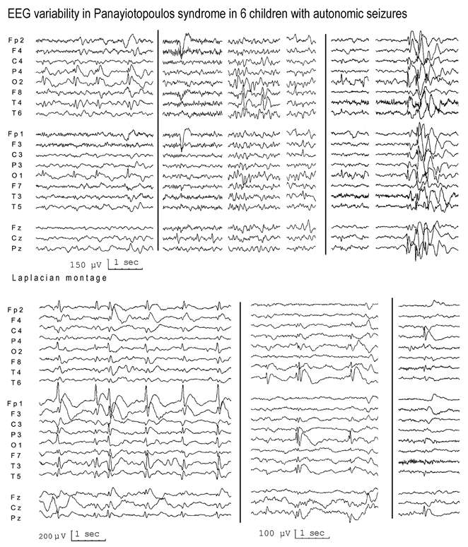 Figure 9.6. EEG variability in Panayiotopoulos syndrome.