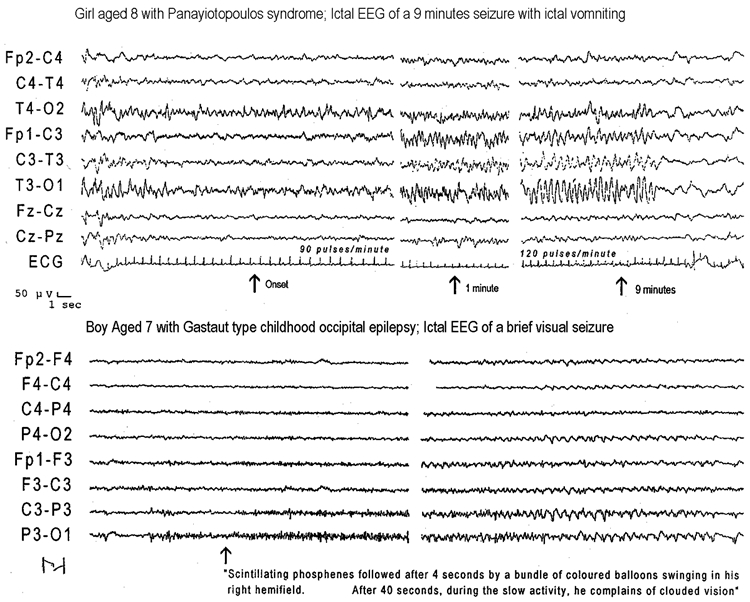 Figure 9.9. Ictal EEGs in Panayiotopoulos syndrome (top) and Gastaut-type childhood occipital epilepsy (bottom).