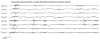 Figure 5.3. Inter-ictal EEG in a neonate with benign neonatal (non-familial) seizures.