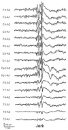 Figure 10.11. Violent Myoclonic Jerks of the Hands Associated with Typical EEG Manifestations.