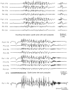 Figure 10.13. Sample from a video EEG of a woman aged 28 years who had suffered from JME since the age of 9 years.