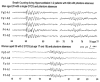 Figure 10.17. Video EEG of two patients suffering from IGE with phantom absences.