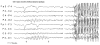 Figure 10.8. Girl Aged 6 Years with Untreated Childhood Absence Epilepsy.