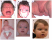 Figure 2. . A boy with WNT5A-associated autosomal dominant Robinow syndrome at different ages.