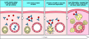 Figure 12.19. Le dépôt de complexes immuns dans les tissus locaux provoque une réponse inflammatoire locale appelée réaction d'Arthus (réaction d'hypersensibilité de type III).