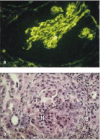 Figure 13.12. Autoantibodies reacting with glomerular basement membrane cause the inflammatory glomerular disease known as Goodpasture's syndrome.