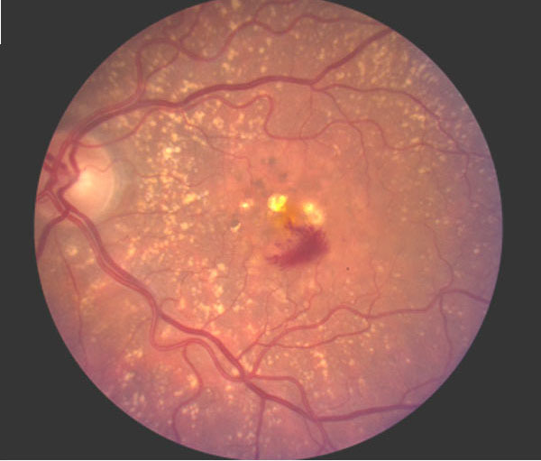 Figure 34 Color Photo Of Subfoveal Cnvm And Hemorrhage Due To Amd Photo From Kmg Files Webvision Ncbi Bookshelf