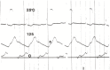 图17.1。严重钙化性主动脉瓣狭窄患者左心室和主动脉压力的同步记录。