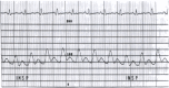 图17.5。在一名心包填塞患者中记录到主动脉压力脉冲（范围为0至200毫米汞柱）。