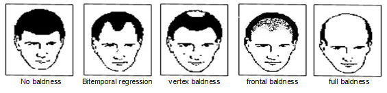 Figure 1. . Androgenetic alopecia patterns in men.
