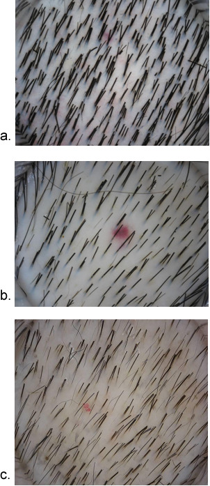 Figure 5. . Dermoscopic images of scalp in different stages of alopecia.