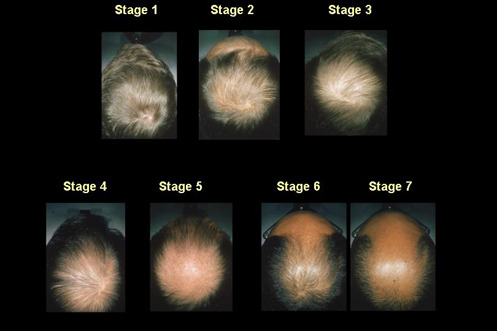 Figure 9. . Modified male pattern hair loss grading scale.