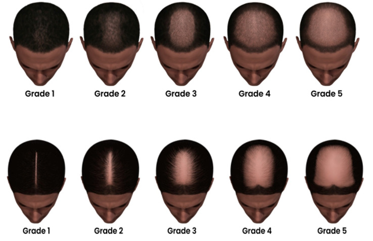 Figure 10. . Modified Sinclair Scale for female pattern hair loss (a less common type of MAA) in men with short hair and long hair.