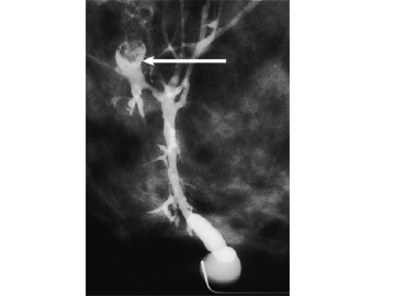Figure 12. Galactogram illustrating space occupying lesion. A catheter is inserted into the duct from which the bloody discharge emerges. Contrast material is then injected through the catheter. The various branches of the duct are outlined.