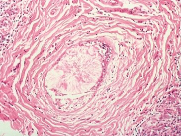 Figure 5. Histological appearance of duct ectasia showing the characteristic crystalline formation of the intraluminal contents.
