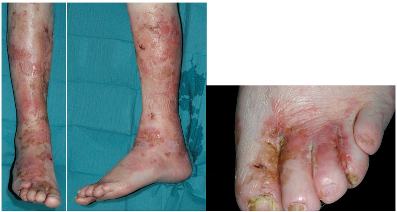 Figure 2. . Necrolytic migratory erythema in a glucagonoma patient.