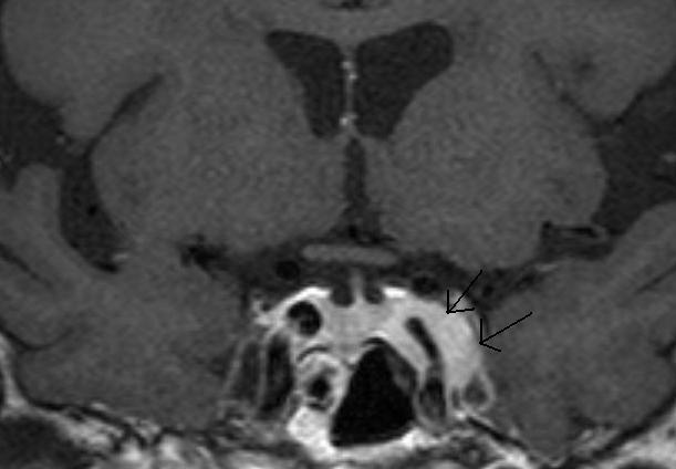 enlarged pituitary gland mri