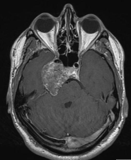 pituitary tumor mri