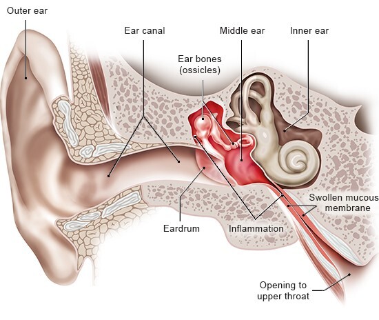 Overview: Middle ear infection - InformedHealth.org - NCBI Bookshelf