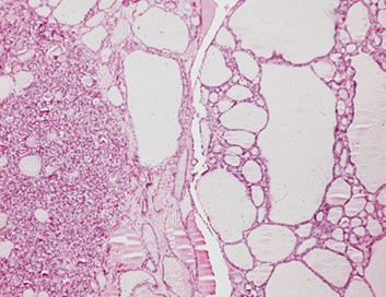 thyroid adenoma histology